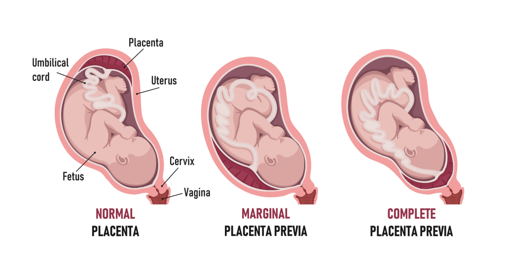 Simptome mai puțin plăcute în sarcină, dar care nu sunt urgențe - Prevenție | Medsana